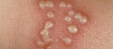 HPV Virüsü Erkek Nasıl Bulaşır?